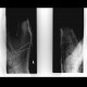 Bennett's fracture: X-ray - Plain radiograph