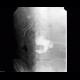 Biloma, leak from biliodigestive anastomosis: RF - Fluoroscopy