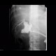 Biloma, leak from biliodigestive anastomosis: RF - Fluoroscopy