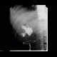 Biloma, leak from biliodigestive anastomosis: RF - Fluoroscopy