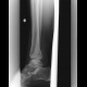 Bimalleolar ankle fracture: X-ray - Plain radiograph