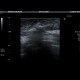 Biopsy of breast: US - Ultrasound