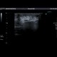 Biopsy of breast: US - Ultrasound
