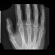 Bone island, metacarpal bone: X-ray - Plain radiograph