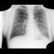 Bronchiectasis: X-ray - Plain radiograph