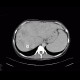 Budd-Chiari syndrome, thrombosis of hepatic veins, liver cirrhosis, TIPSS, splenomegally: CT - Computed tomography