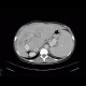 Budd-Chiari syndrome, thrombosis of hepatic veins, liver cirrhosis, TIPSS, splenomegally: CT - Computed tomography