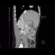 Budd-Chiari syndrome, thrombosis of hepatic veins, liver cirrhosis, TIPSS, splenomegally: CT - Computed tomography