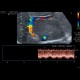 Budd-Chiari syndrome, thrombosis of hepatic veins, liver cirrhosis, TIPSS, splenomegally: US - Ultrasound