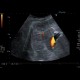 Budd-Chiari syndrome, thrombosis of hepatic veins, liver cirrhosis, TIPSS, splenomegally: US - Ultrasound