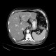 Burkitt's lymphoma of small bowel and liver: CT - Computed tomography