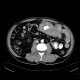 Burkitt's lymphoma of small bowel and liver: CT - Computed tomography