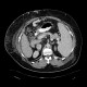 Caput medusae, liver cirrhosis, alcoholic liver cirrhosis, portal hypertension, splenomegally: CT - Computed tomography