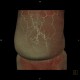 Caput medusae, liver cirrhosis, alcoholic liver cirrhosis, portal hypertension, splenomegally: CT - Computed tomography