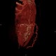 Caput medusae, liver cirrhosis, alcoholic liver cirrhosis, portal hypertension, splenomegally: CT - Computed tomography