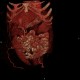 Caput medusae, liver cirrhosis, alcoholic liver cirrhosis, portal hypertension, splenomegally: CT - Computed tomography