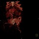 Caput medusae, liver cirrhosis, alcoholic liver cirrhosis, portal hypertension, splenomegally: CT - Computed tomography