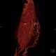 Caput medusae, liver cirrhosis, alcoholic liver cirrhosis, portal hypertension, splenomegally: CT - Computed tomography