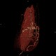 Caput medusae, liver cirrhosis, alcoholic liver cirrhosis, portal hypertension, splenomegally: CT - Computed tomography