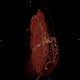 Caput medusae, liver cirrhosis, alcoholic liver cirrhosis, portal hypertension, splenomegally: CT - Computed tomography