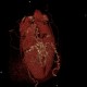 Caput medusae, liver cirrhosis, alcoholic liver cirrhosis, portal hypertension, splenomegally: CT - Computed tomography