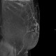 Caput medusae, liver cirrhosis, alcoholic liver cirrhosis, portal hypertension, splenomegally: CT - Computed tomography