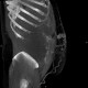 Caput medusae, liver cirrhosis, alcoholic liver cirrhosis, portal hypertension, splenomegally: CT - Computed tomography
