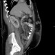 Caput medusae, liver cirrhosis, alcoholic liver cirrhosis, portal hypertension, splenomegally: CT - Computed tomography