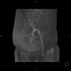 Caput medusae, liver cirrhosis, alcoholic liver cirrhosis, portal hypertension, splenomegally: CT - Computed tomography