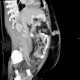 Caput medusae, liver cirrhosis, alcoholic liver cirrhosis, portal hypertension, splenomegally: CT - Computed tomography