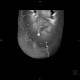 Caput medusae, liver cirrhosis, alcoholic liver cirrhosis, portal hypertension, splenomegally: CT - Computed tomography