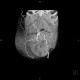 Caput medusae, liver cirrhosis, alcoholic liver cirrhosis, portal hypertension, splenomegally: CT - Computed tomography