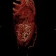 Caput medusae, liver cirrhosis, alcoholic liver cirrhosis, portal hypertension, splenomegally: CT - Computed tomography