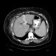 Caput medusae, liver cirrhosis, alcoholic liver cirrhosis, portal hypertension, splenomegally: CT - Computed tomography