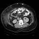 Caput medusae, liver cirrhosis, alcoholic liver cirrhosis, portal hypertension, splenomegally: CT - Computed tomography