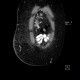 Caput medusae, liver cirrhosis, alcoholic liver cirrhosis, portal hypertension, splenomegally: CT - Computed tomography