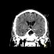 Cavum septi pellucidi, cavum vergae: CT - Computed tomography