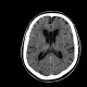 Cavum septi pellucidi, cavum vergae: CT - Computed tomography