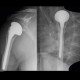 CCEP, shoulder joint, cervico-capital endoprosthesis: X-ray - Plain radiograph