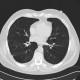 Centrilobular emphysema: CT - Computed tomography