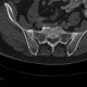 Trepanobiopsy channel: CT - Computed tomography