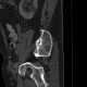 Trepanobiopsy channel: CT - Computed tomography