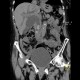 Choledocholithiasis, bile duct stones: CT - Computed tomography