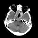Chordoma of clivus, recurrence: CT - Computed tomography