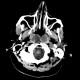 Chordoma of clivus, recurrence: CT - Computed tomography
