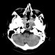 Chordoma of clivus, recurrence: CT - Computed tomography