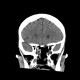 Chordoma of clivus, recurrence: CT - Computed tomography