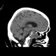 Chordoma of clivus, preoperative: CT - Computed tomography