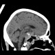 Chordoma of clivus, preoperative: CT - Computed tomography