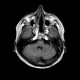 Chordoma of clivus, preoperative: MRI - Magnetic Resonance Imaging